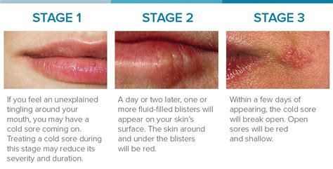 cold sore pics stages